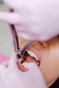 Patient having a tooth extraction at a dental clinic in Richmond Hill