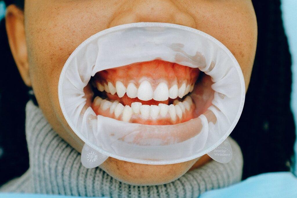 Open mouth during a dental checkup using a cheek retractor