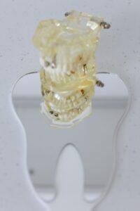 Why Is My Gum Swollen Around One Tooth?