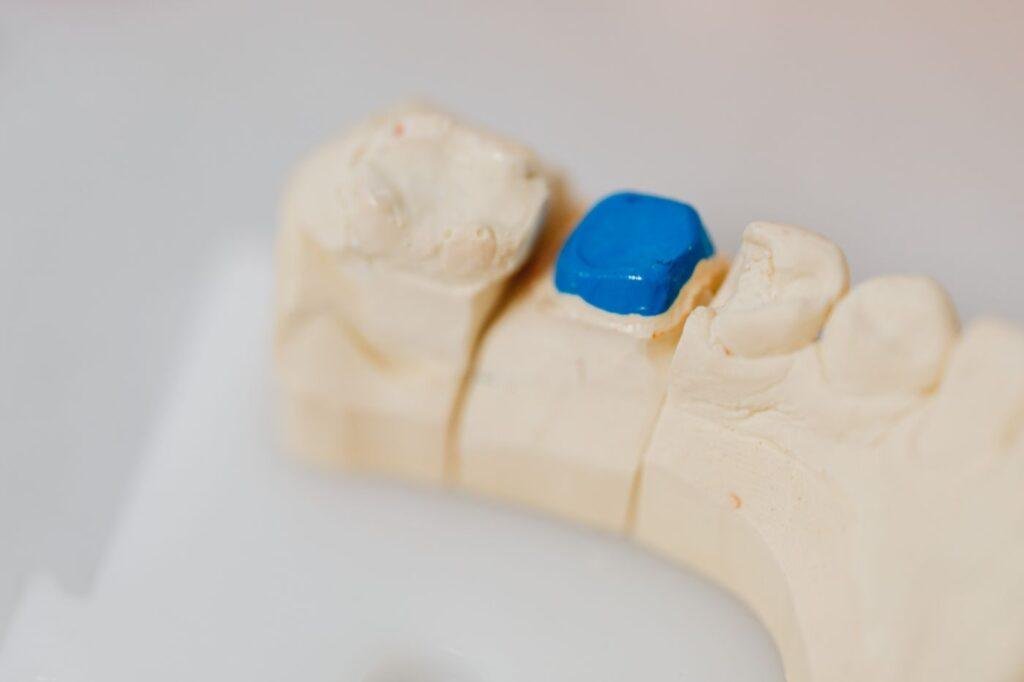 Dental jaw model showing a blue filling in a tooth